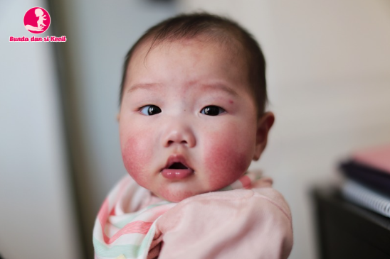 Tortikolis pada Bayi: Gejala, Penyebab, dan Cara Mengatasi Sejak Dini